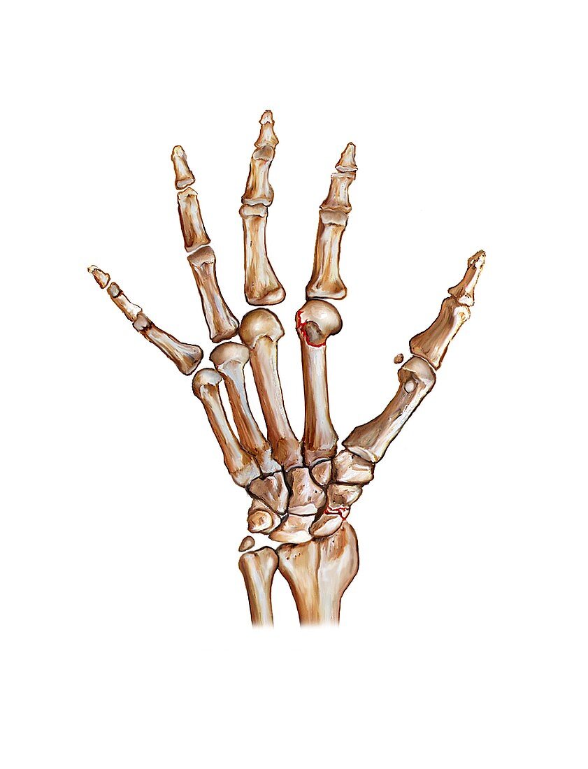 Fractured wrist and hand bones,artwork