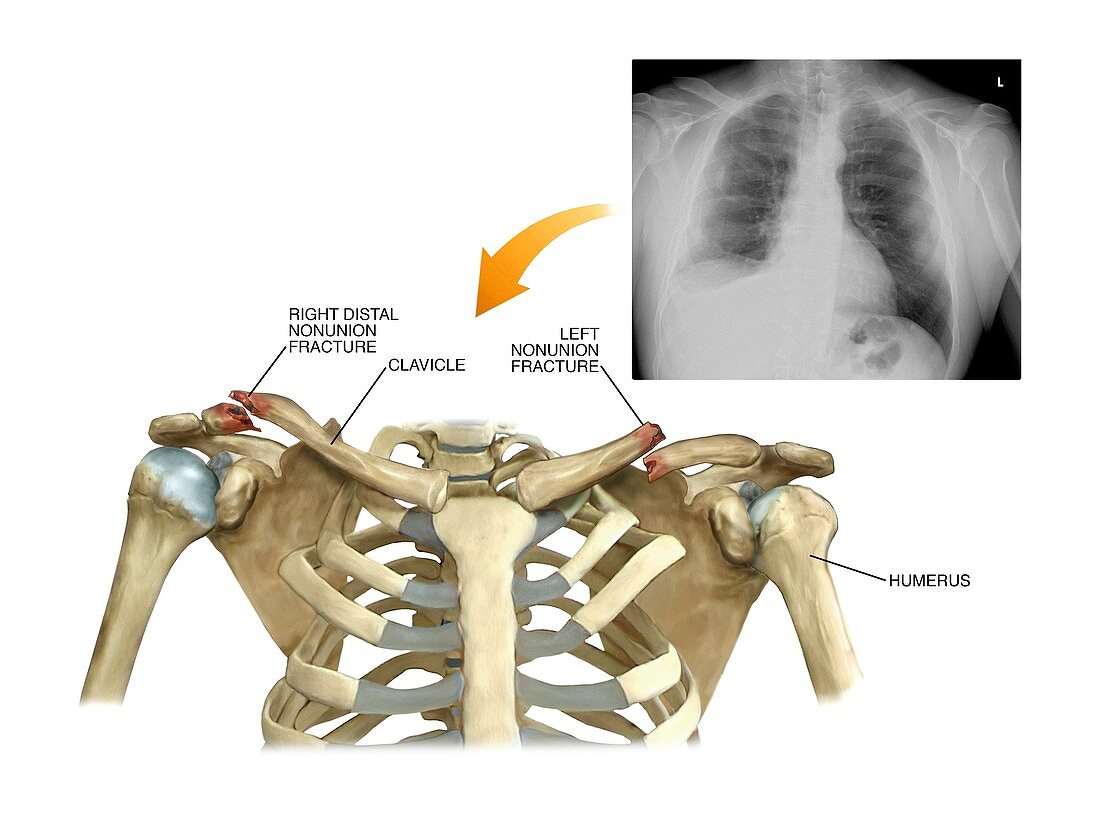 Bilateral collar bone fractures