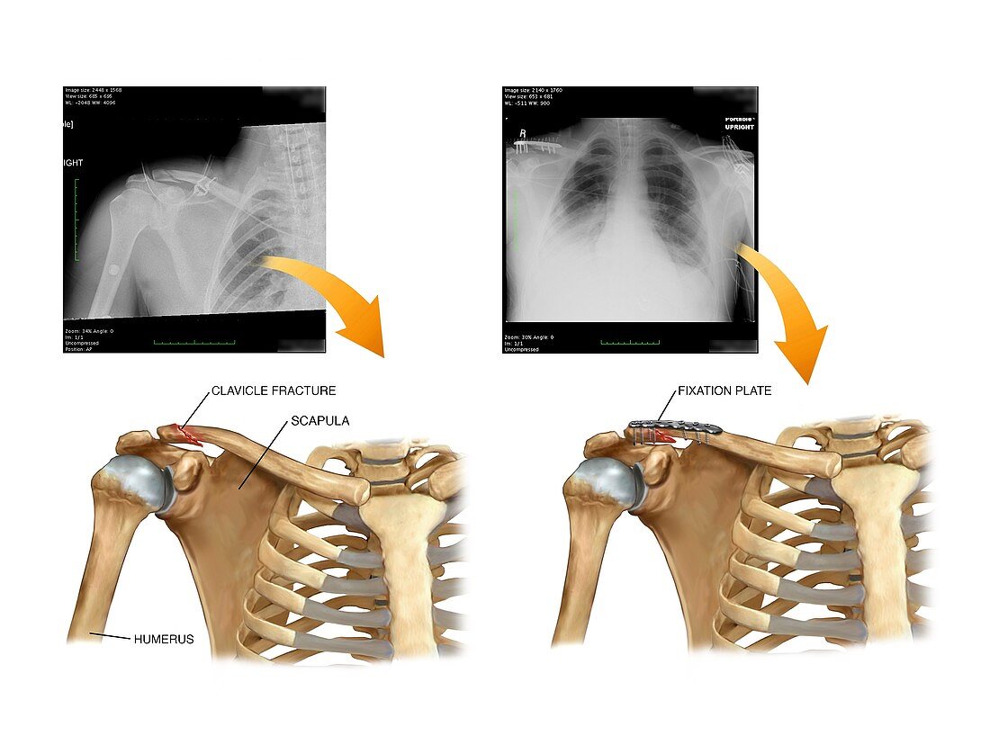 Internal fixation of broken collar bone