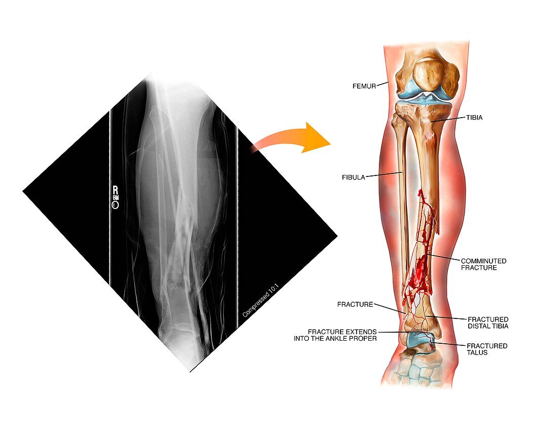 Comminuted fracture of the tibia