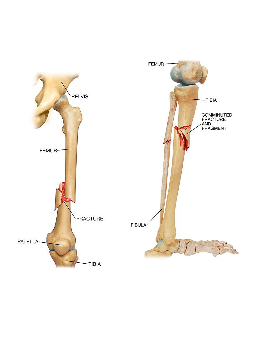 Fractures of the femur and tibia,artwork