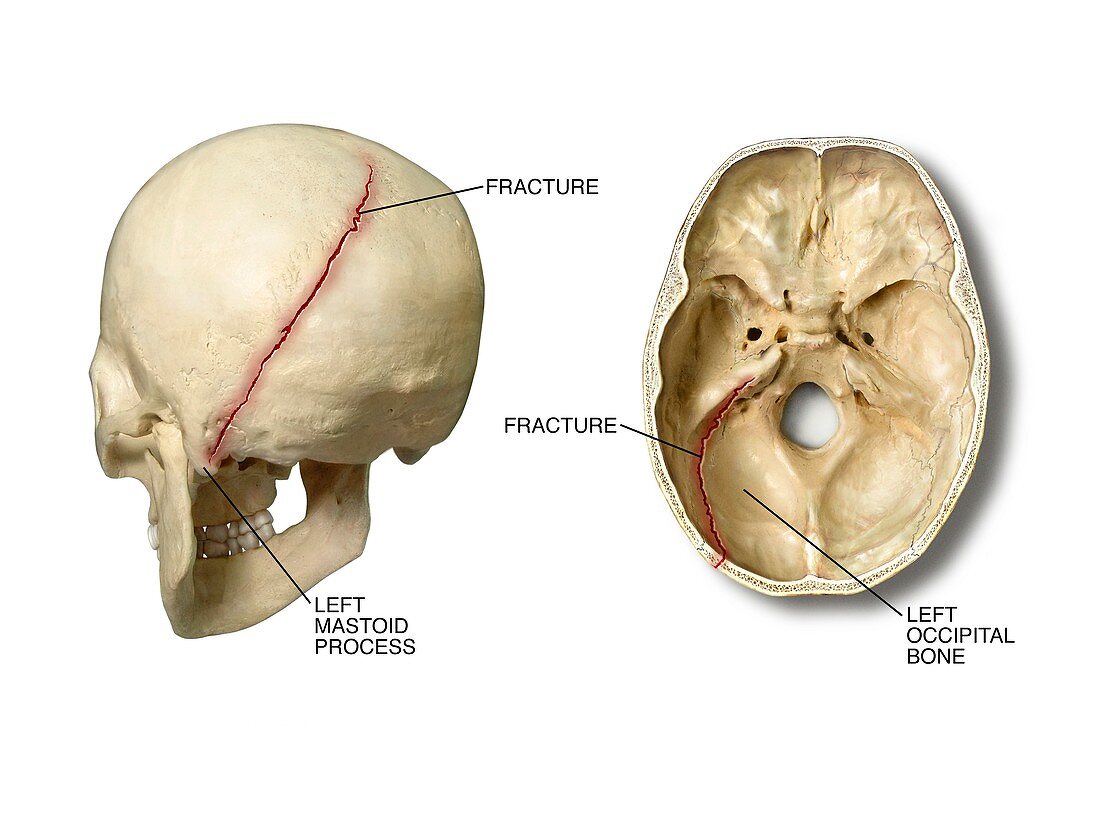 Left posterior occipital skull fracture
