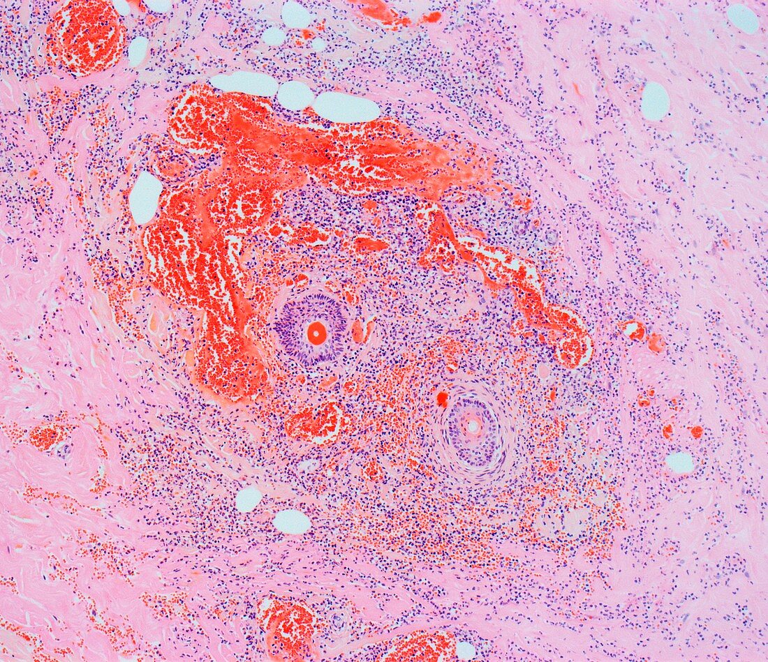 Necrotizing fasciitis,light micrograph