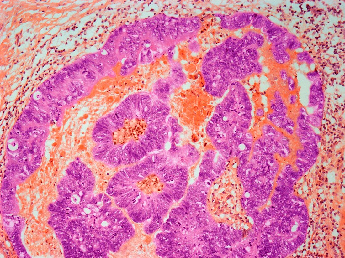 Umbilical adenoma,light micrograph