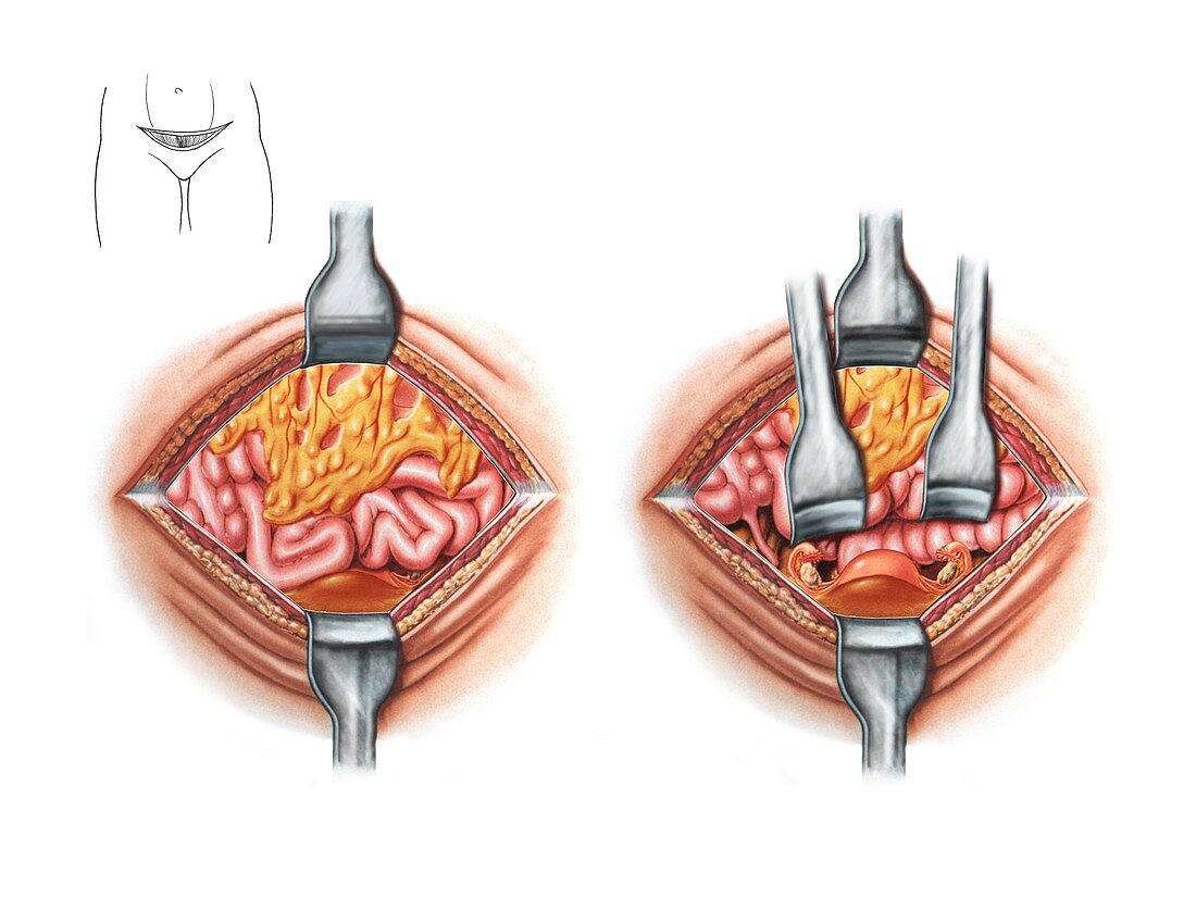 Hysterectomy incision,artwork