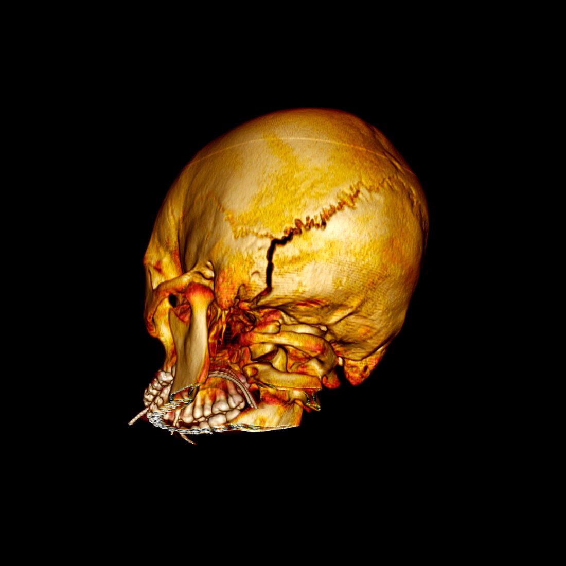 Occipital skull fracture,3D model