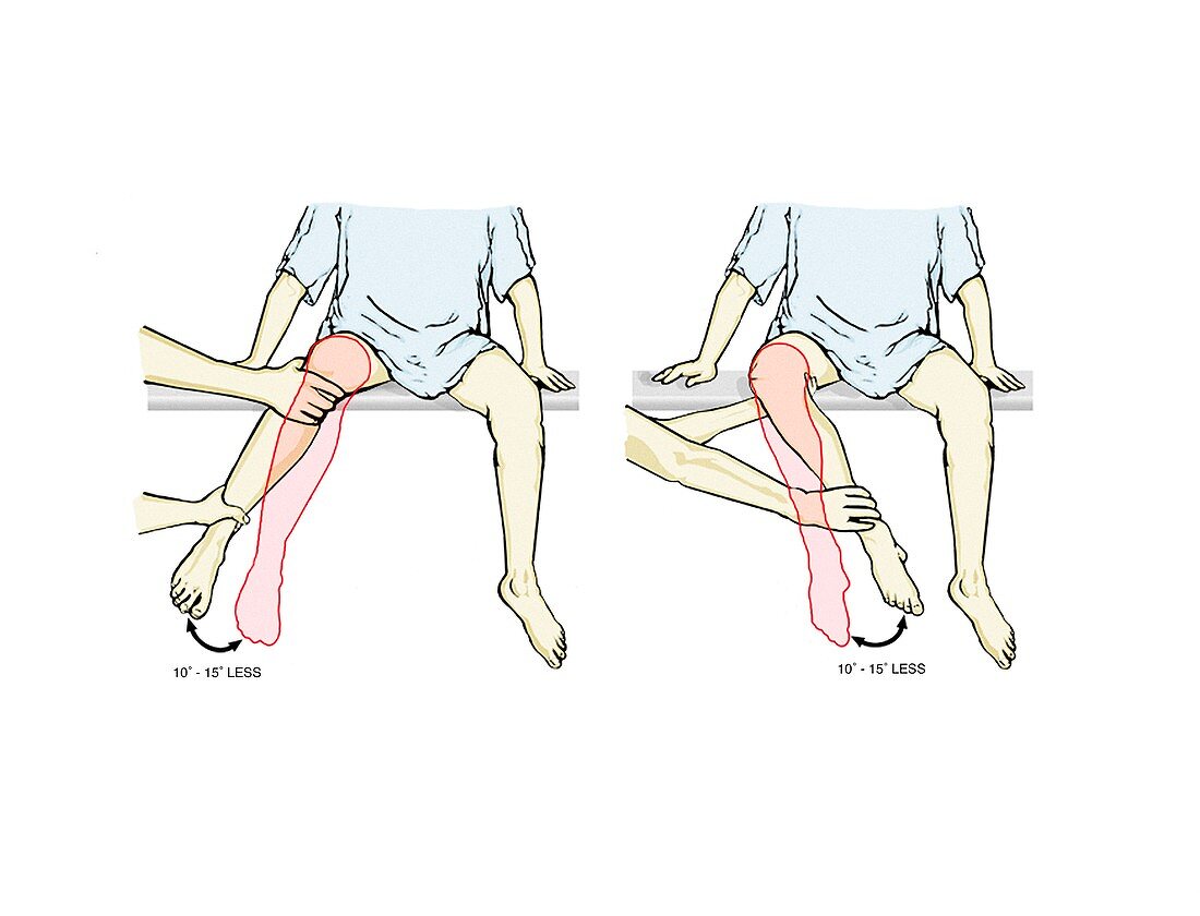 External-internal hip rotation exam
