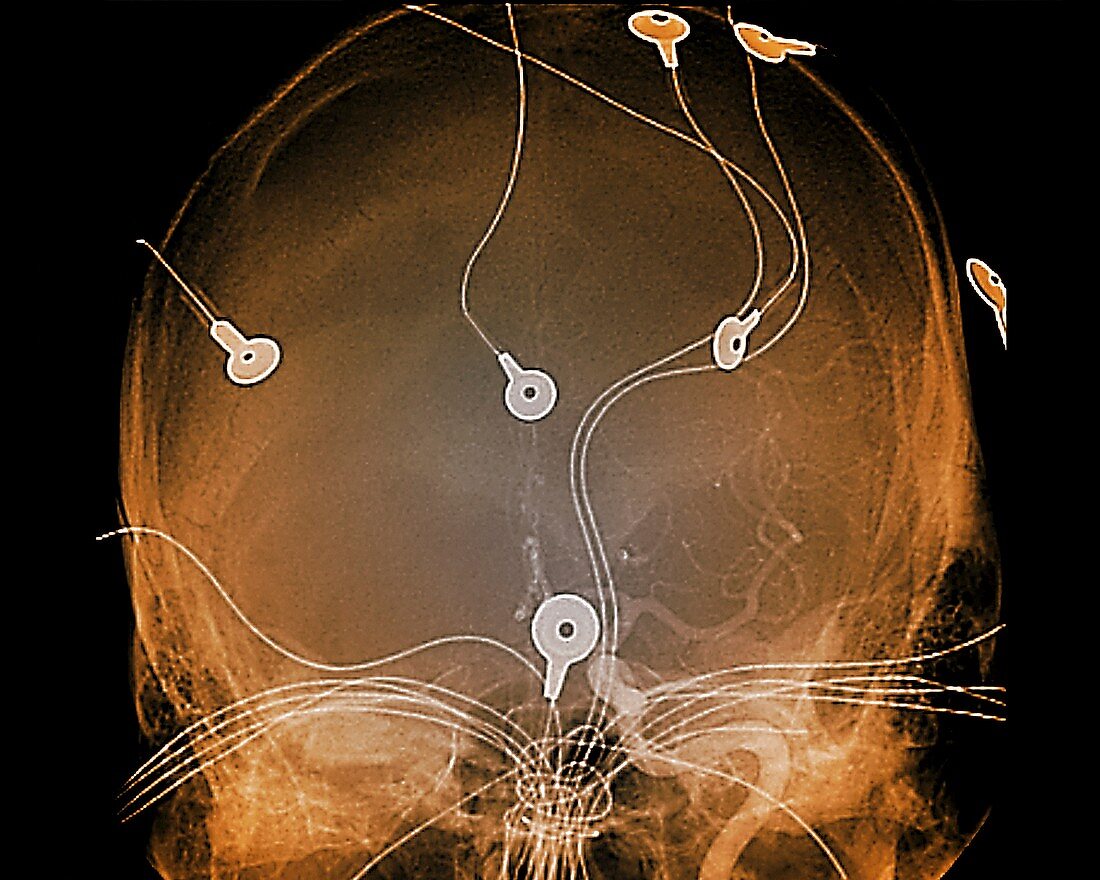 Electroencephalography,angiogram