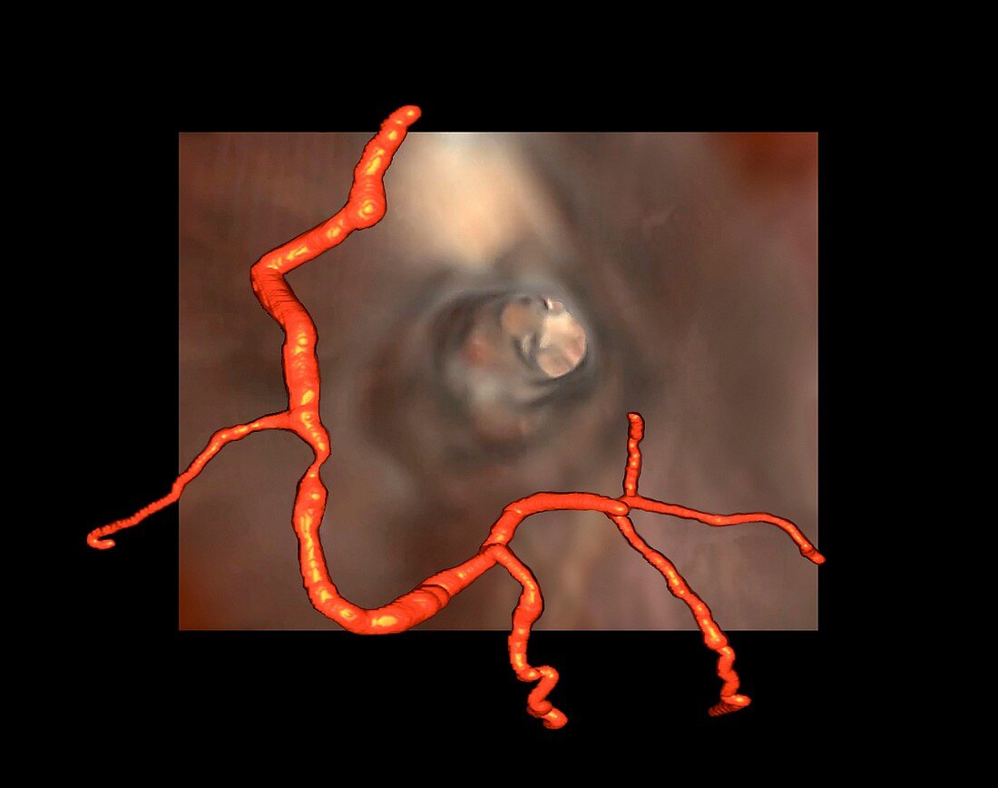 Coronary stenosis,3D CT scan