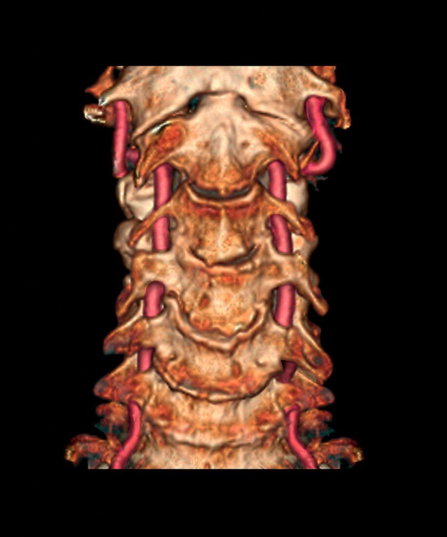 Arthritis of the neck,3D CT scan
