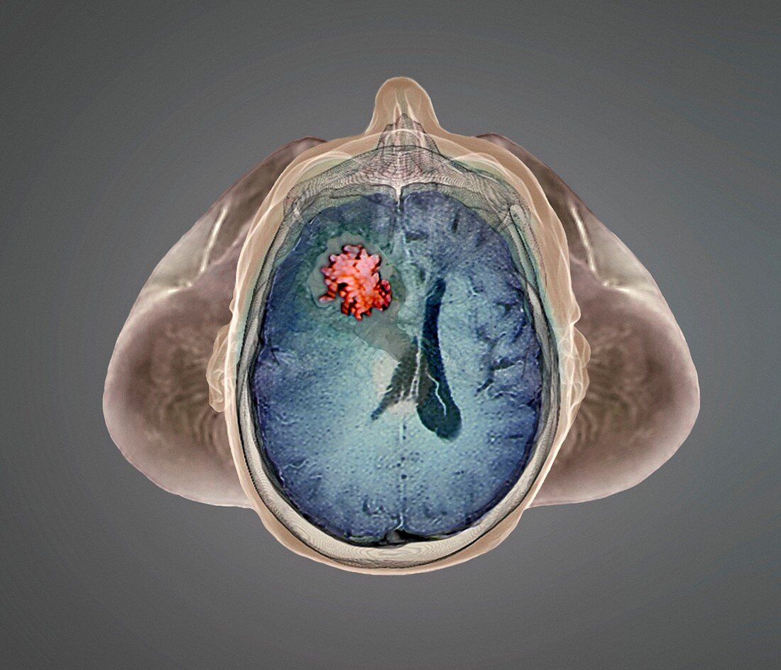 Brain tumour,fMRI