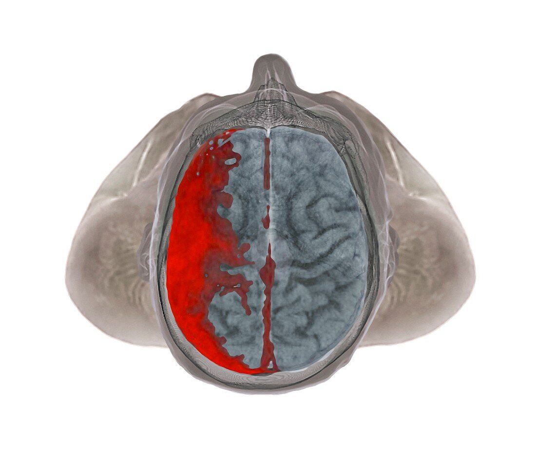 Brain haemorrhage,3D MRI and CT scans