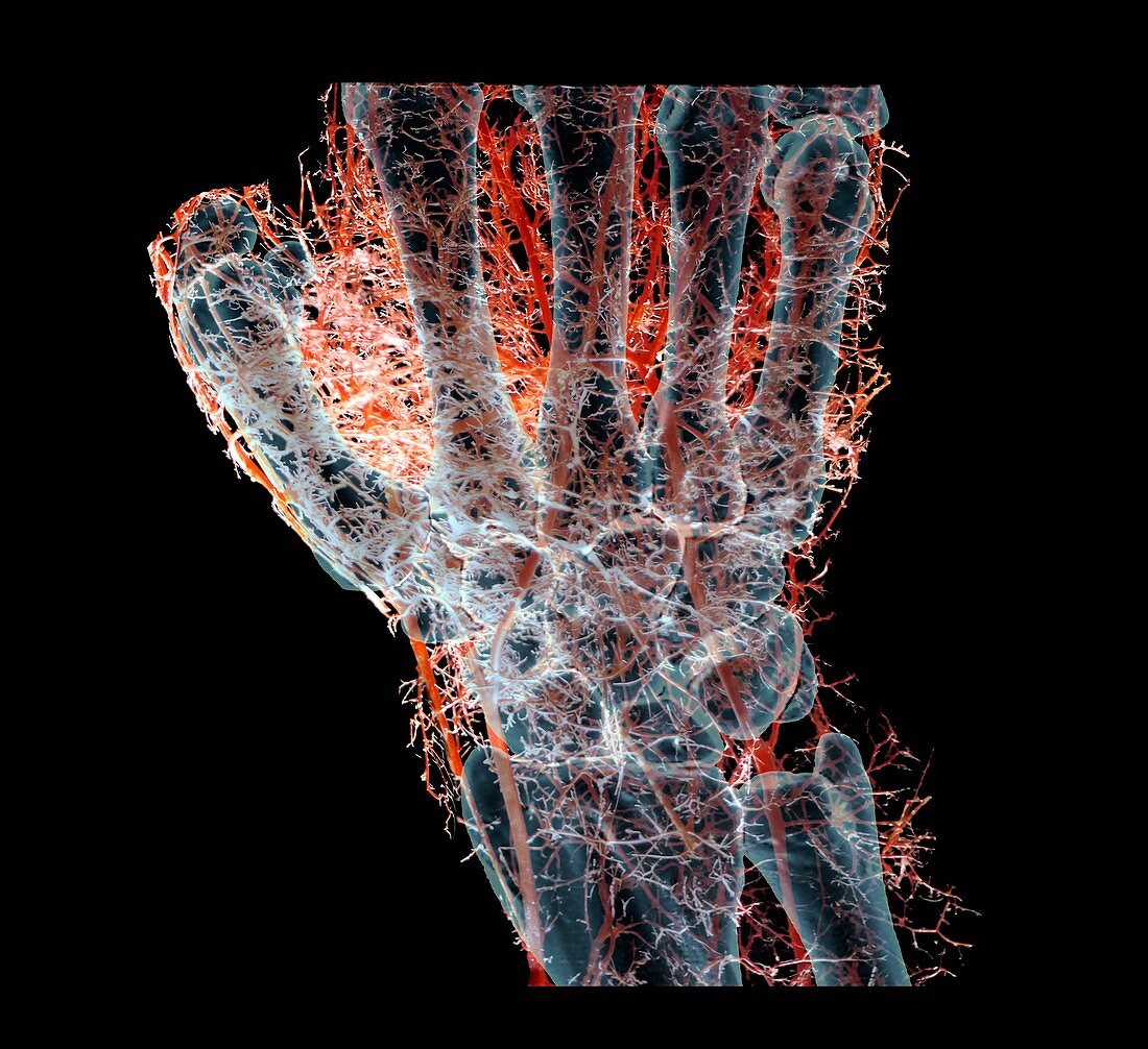 Human hand blood vessels,composite image