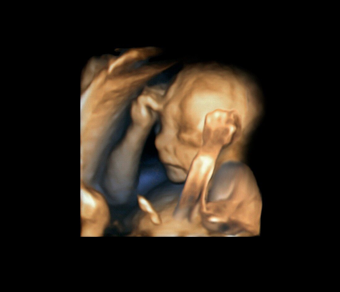 Foetus,3D ultrasound scan