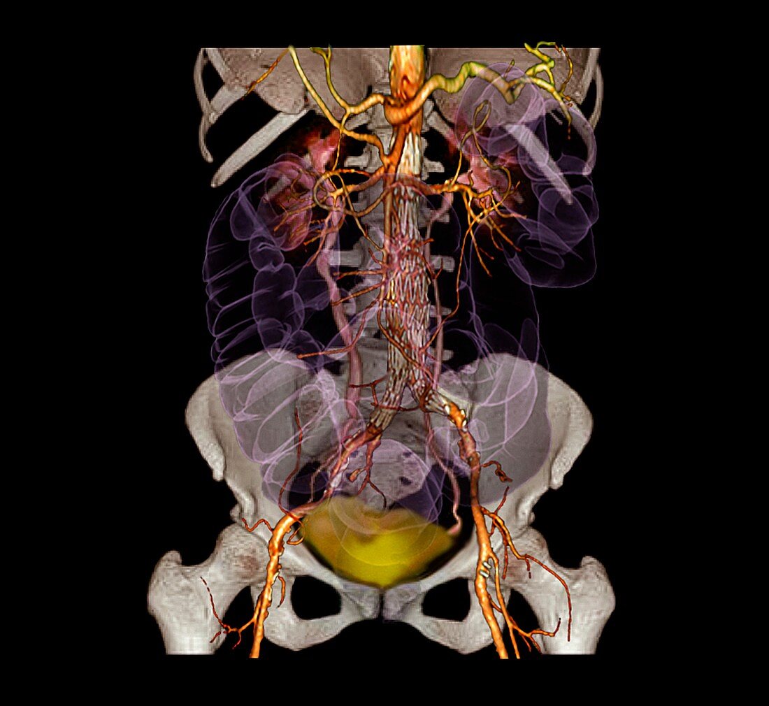 Abdominal aneurysm,3D CT angiogram