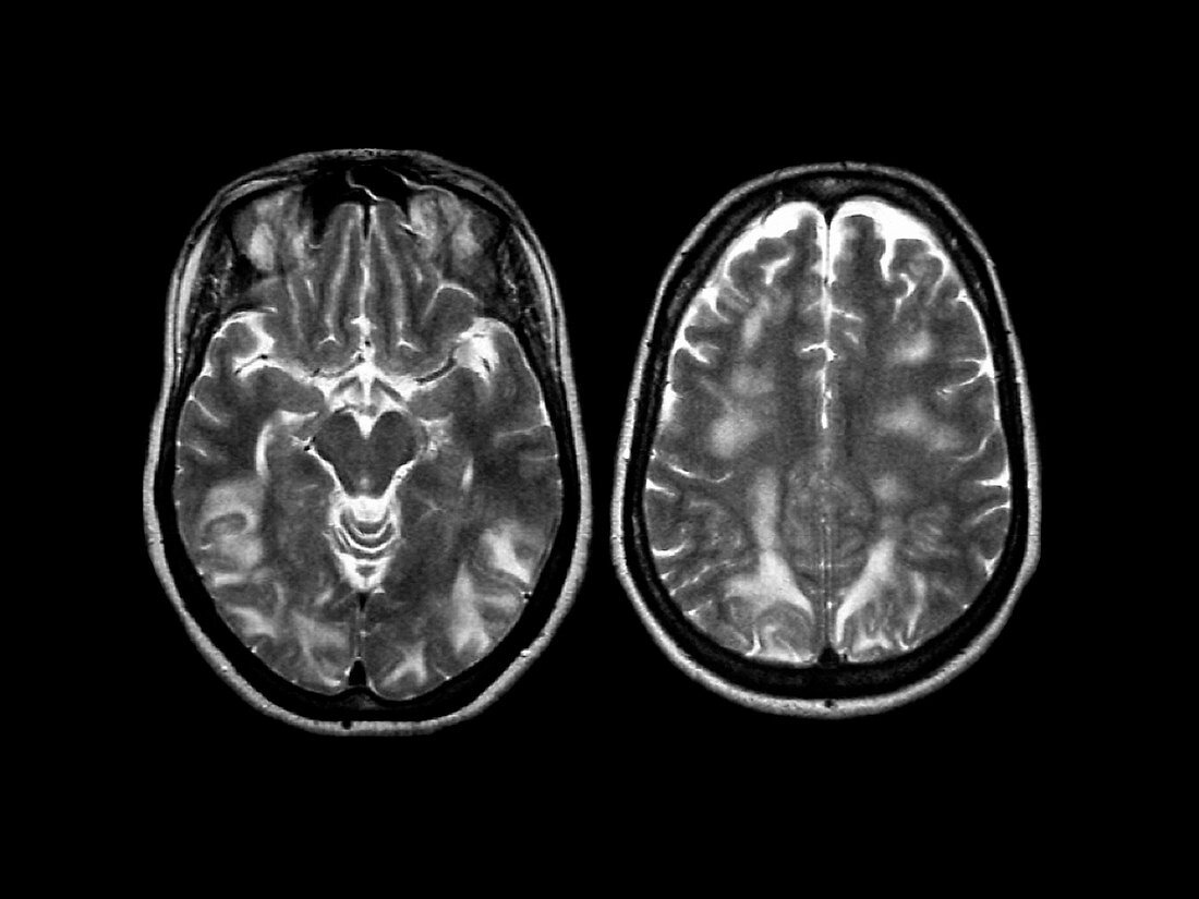 Eclampsia,MRI scan