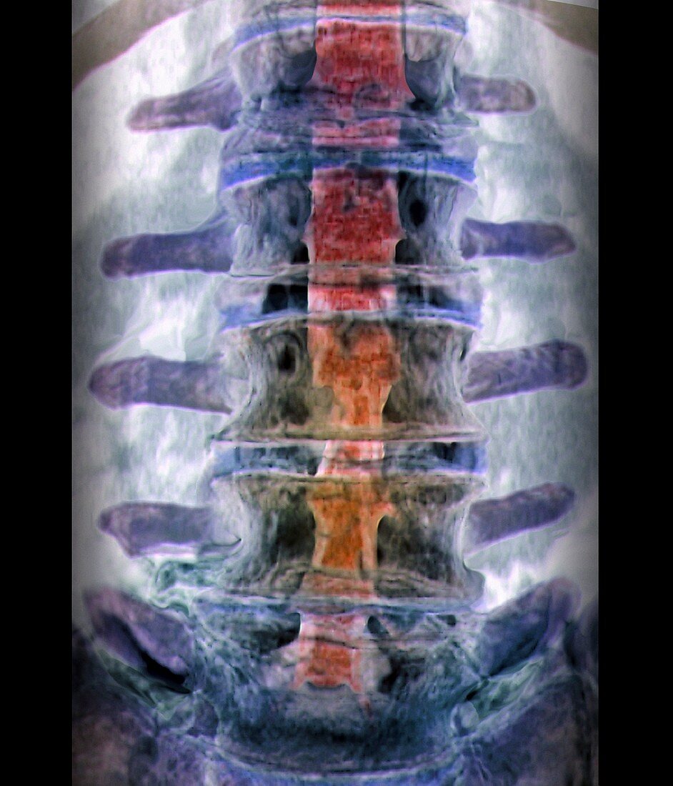 Slipped disc,3D CT scan