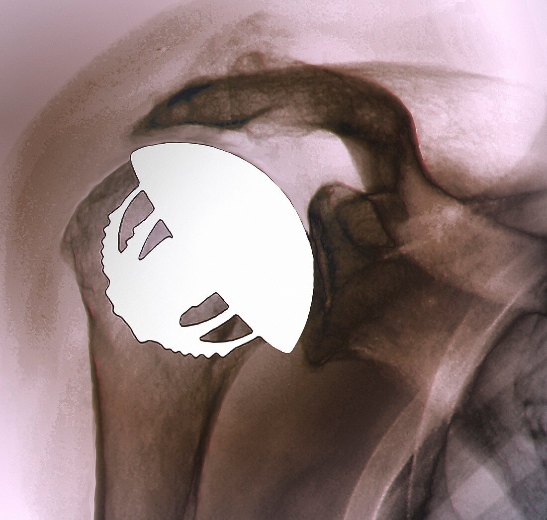 Shoulder replacement,X-ray