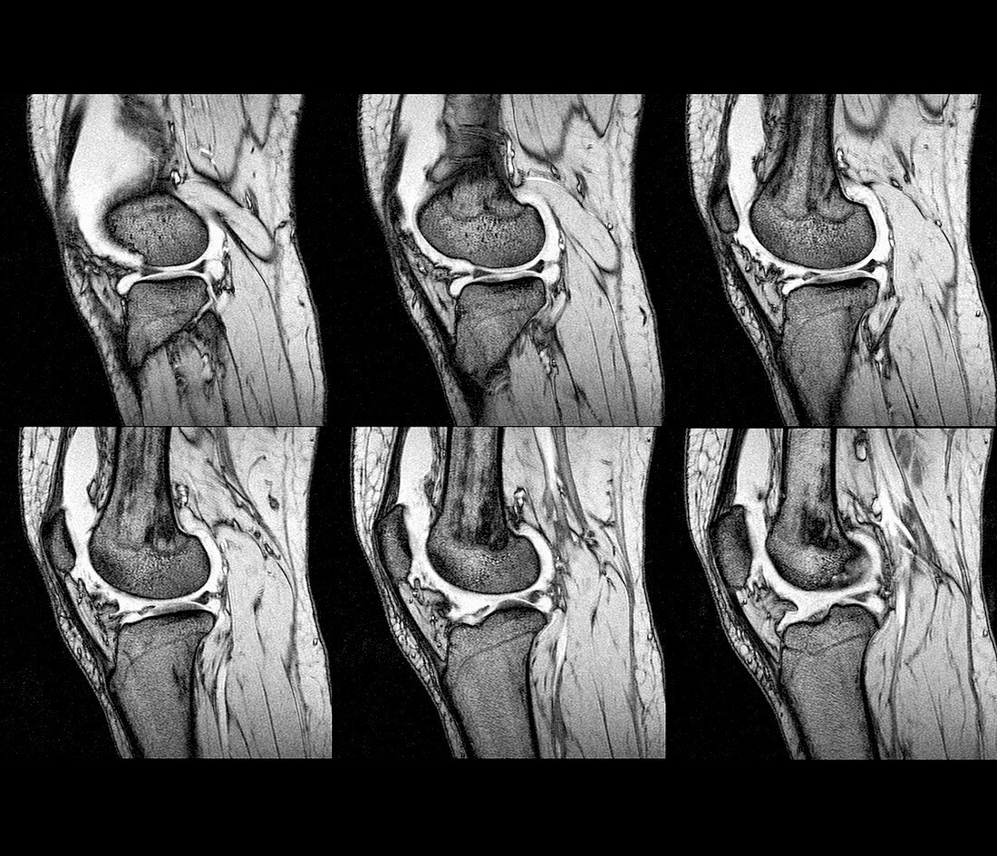 Knee sprain,MRI scans