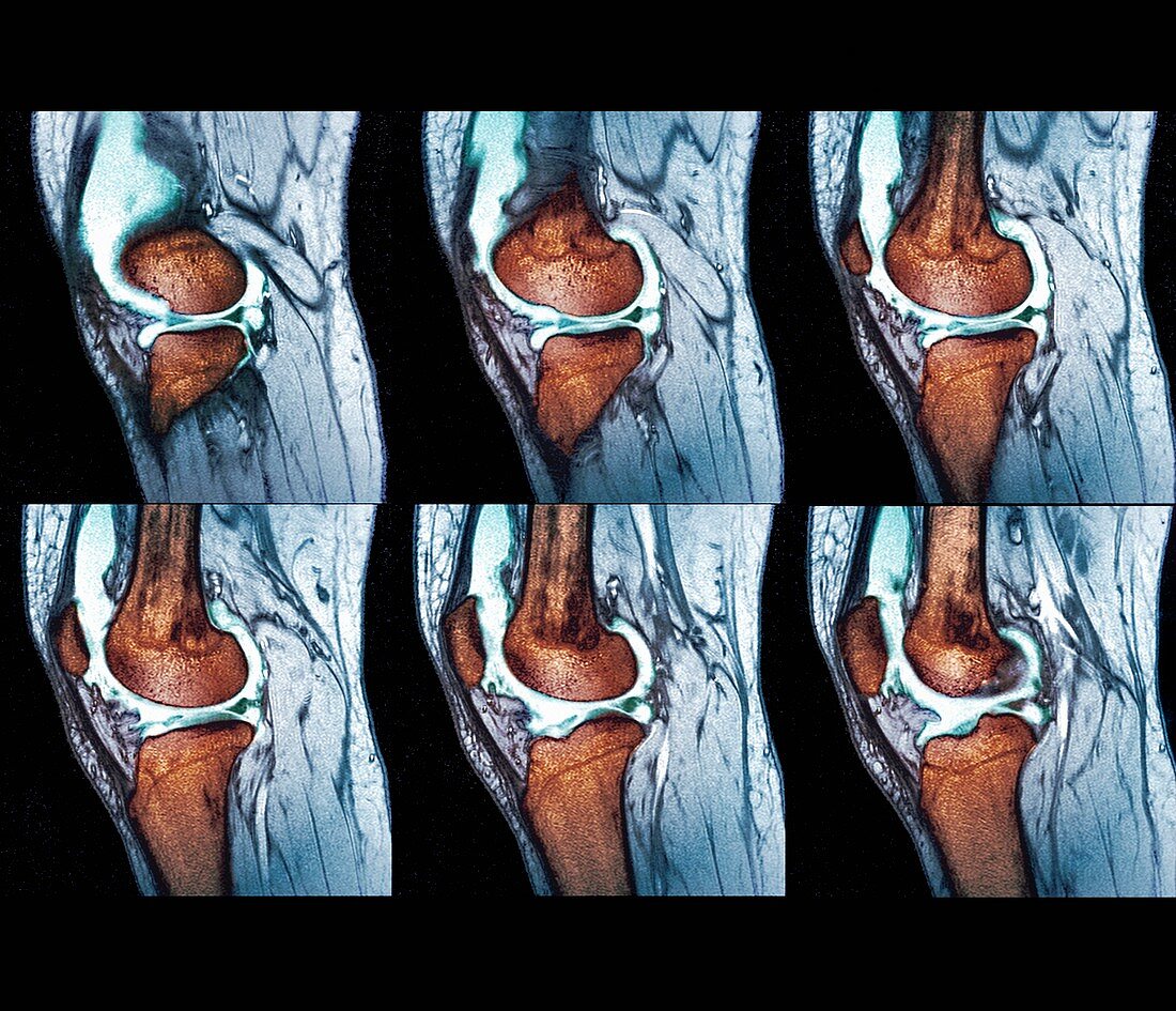 Knee sprain,MRI scans