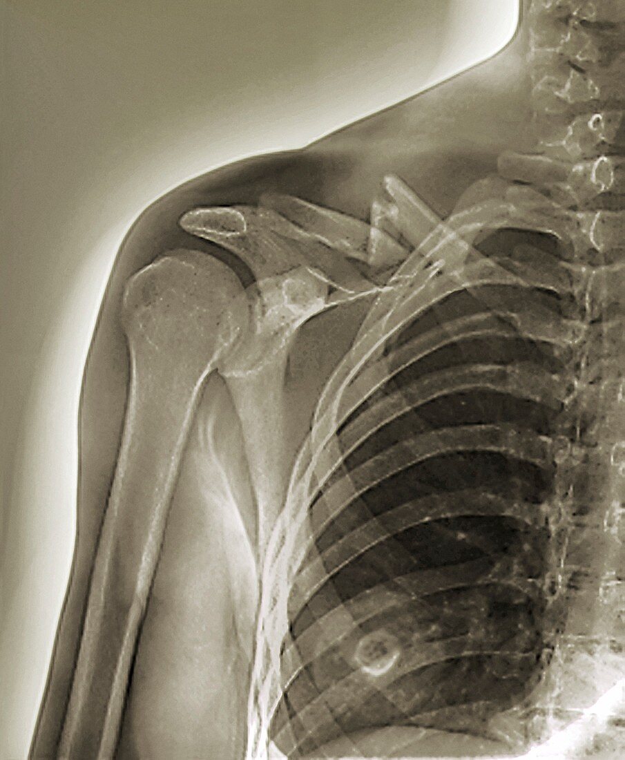 Collar bone fracture,X-ray