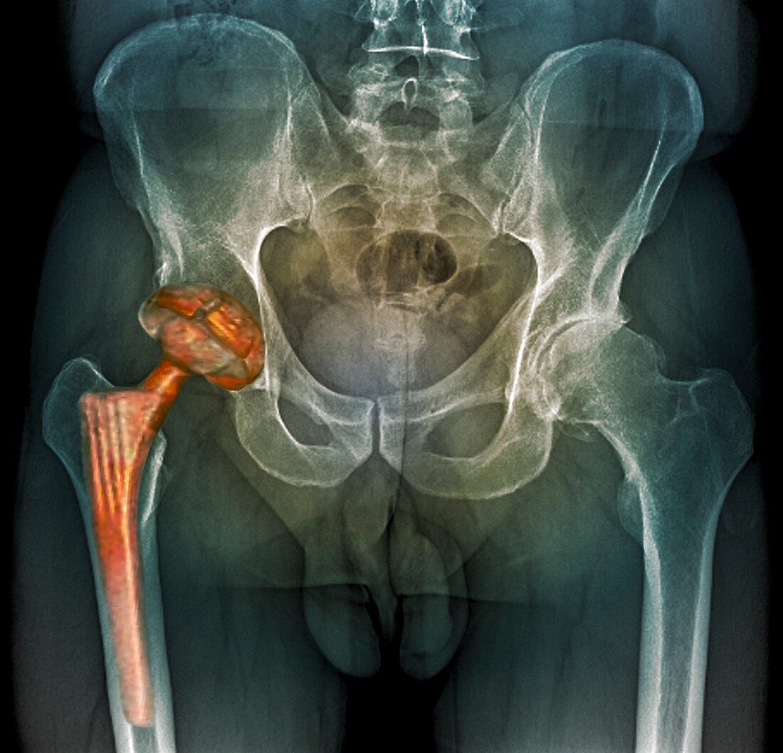 Hip replacement,3D CT scan