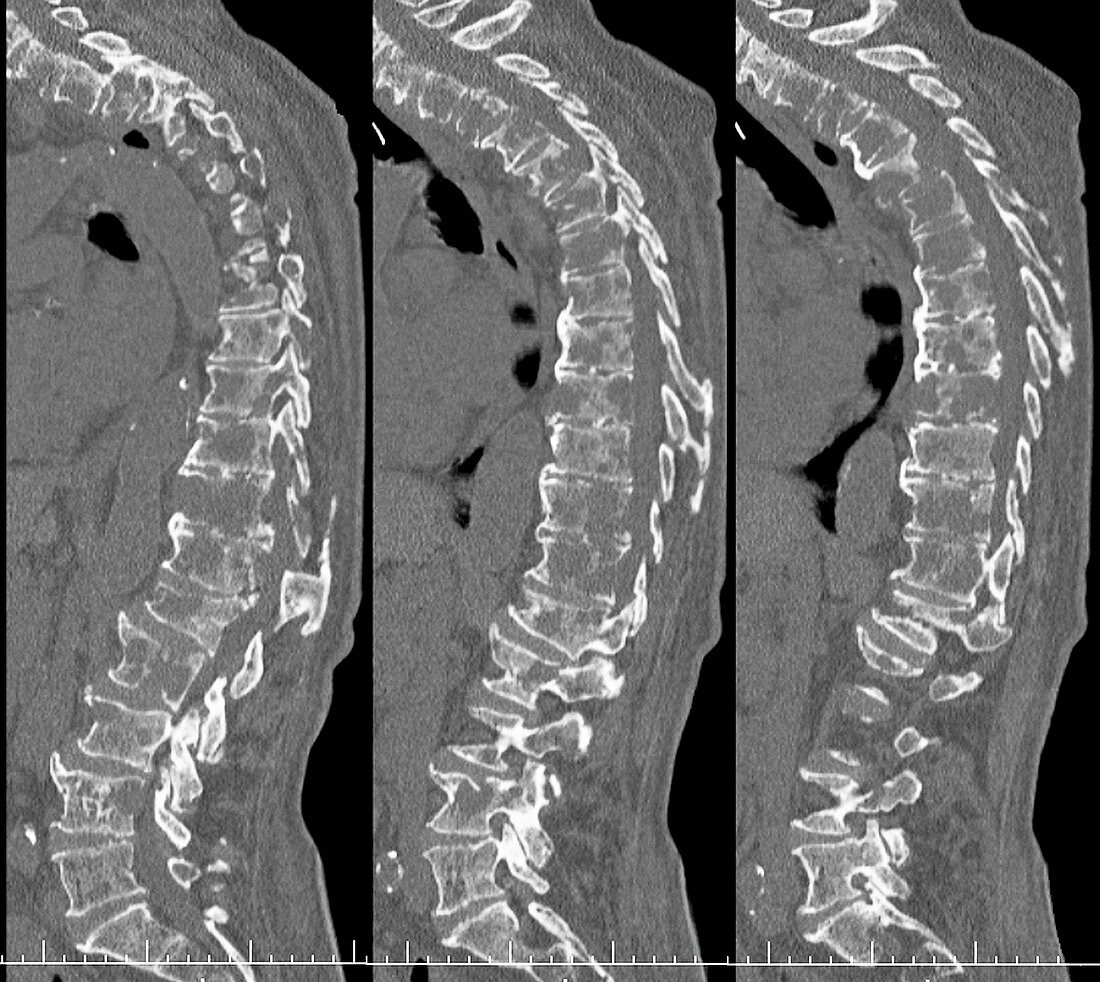 Secondary spinal cancer,CT scans