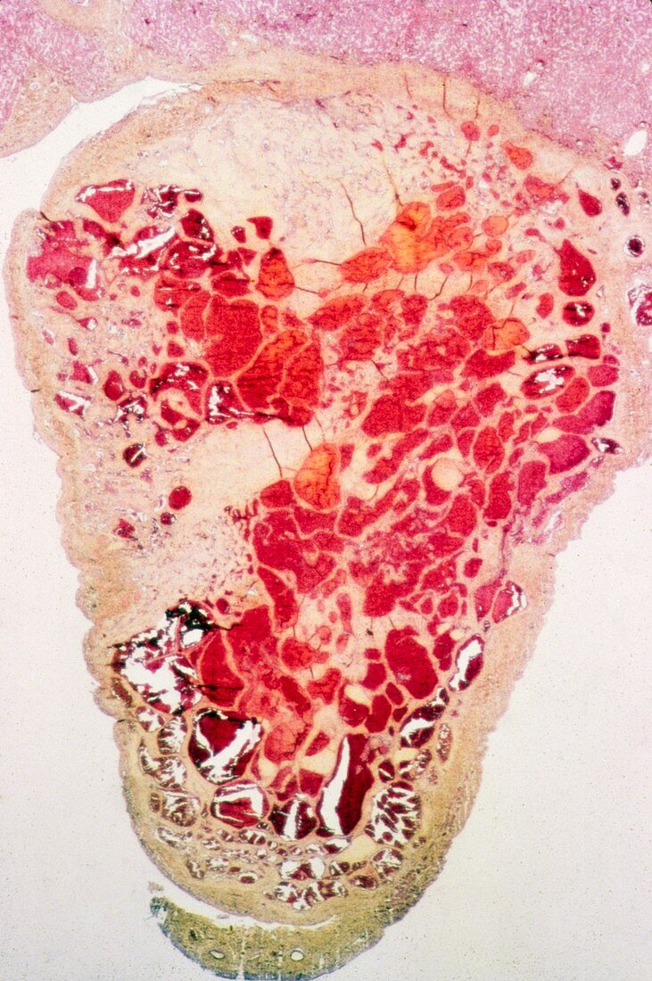 Liver haemangioma,light micrograph