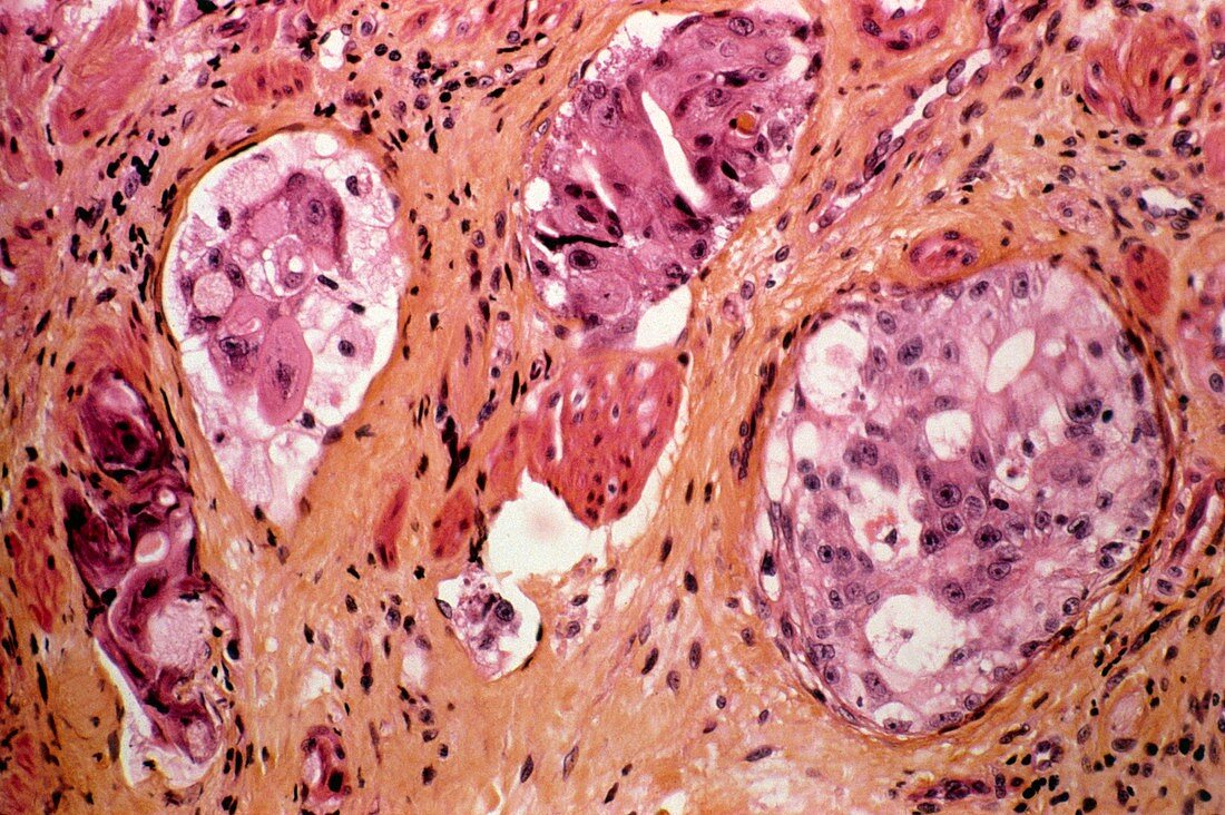 Stomach cancer,light micrograph