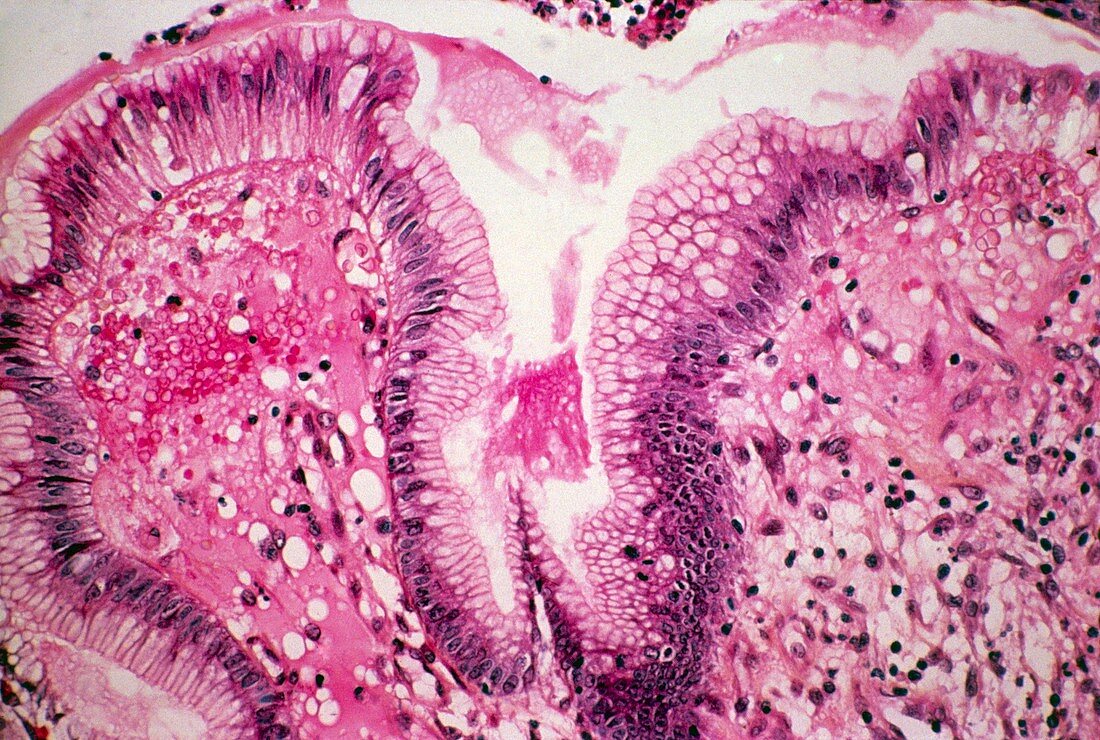 Stomach ulcer,light micrograph