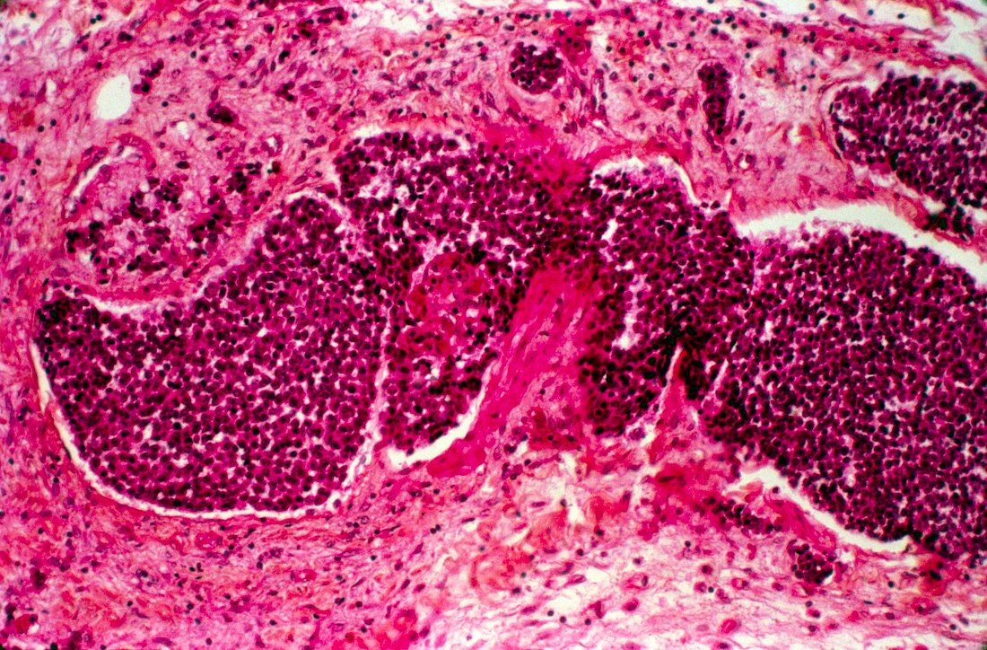 Pancreatic cancer,light micrograph