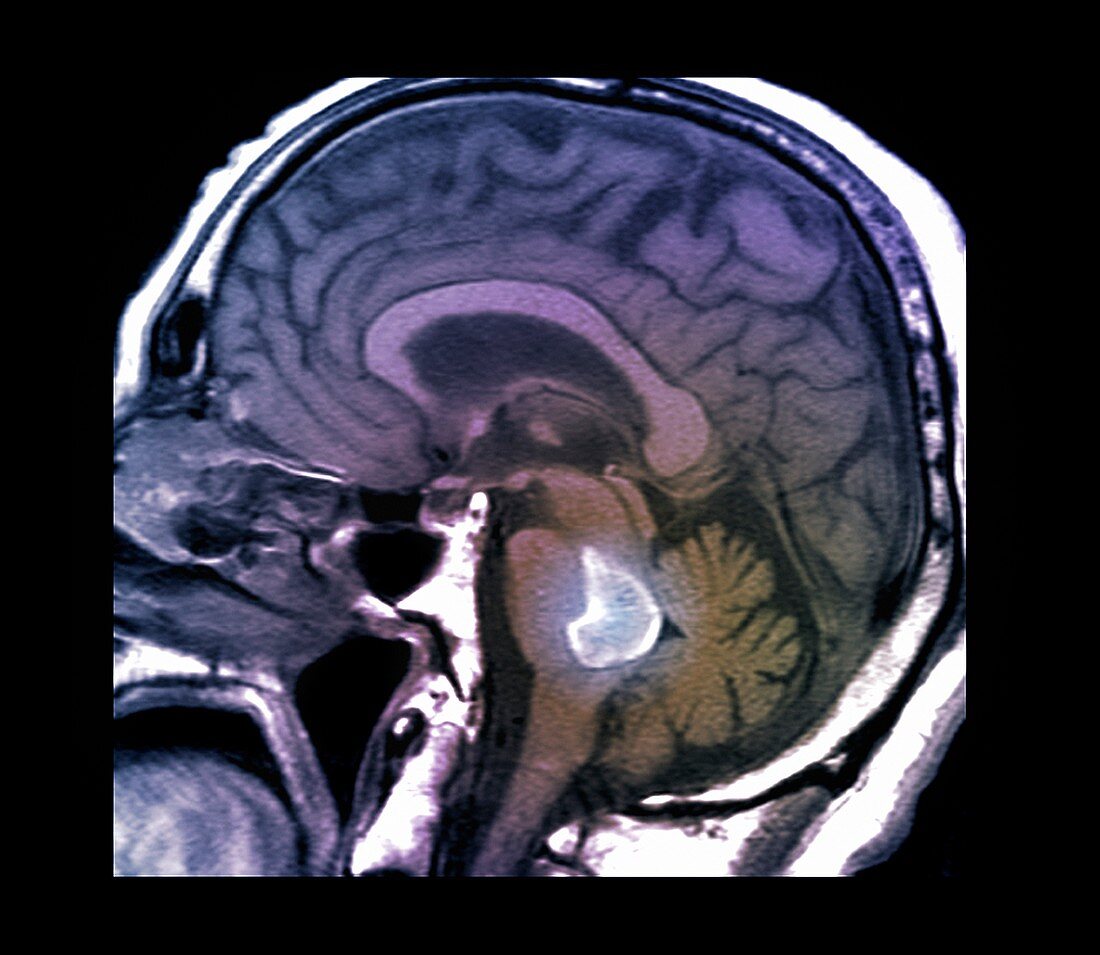 Brain haemorrhage,MRI scan