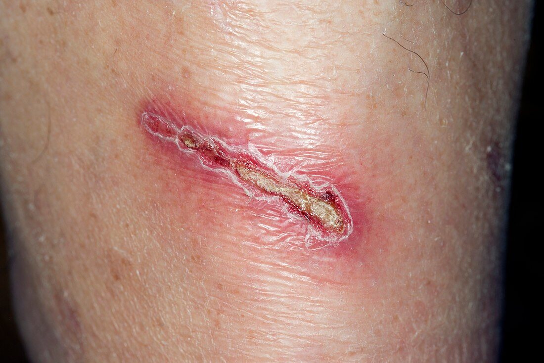 Infected laceration of the shin