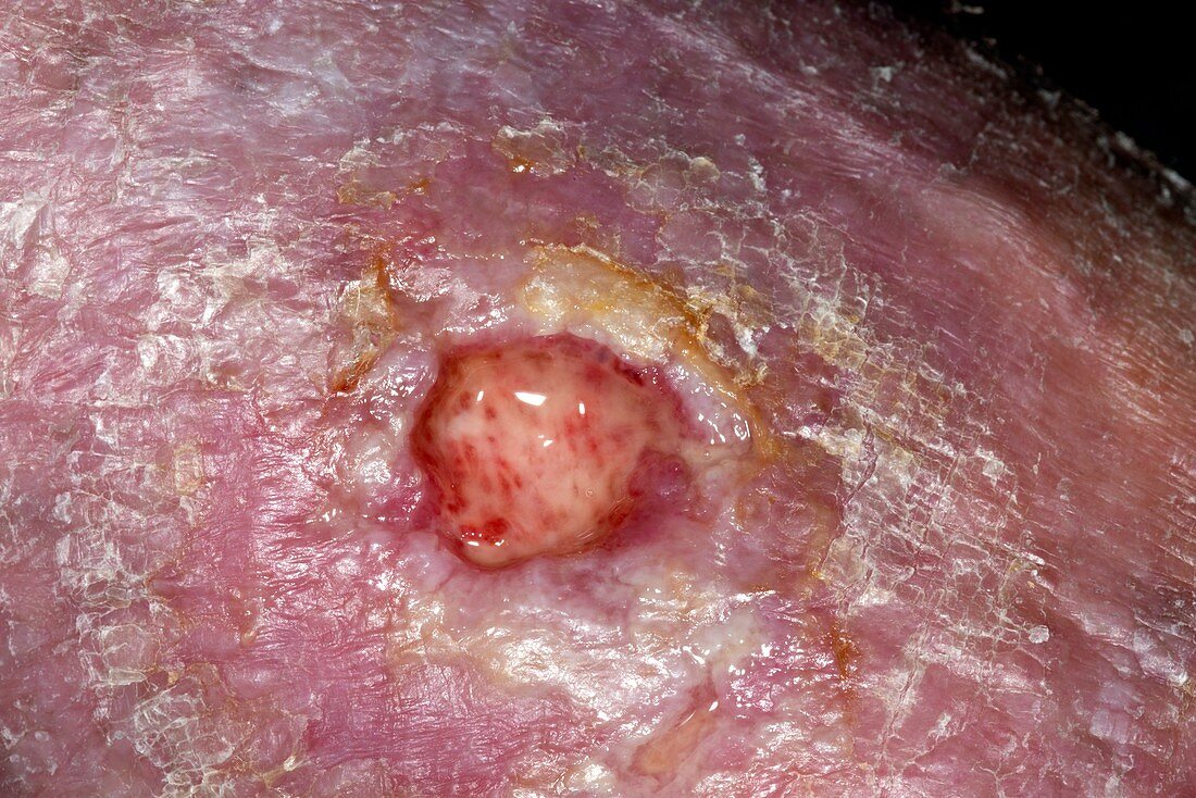 Infected arterial ulcer in a diabetic