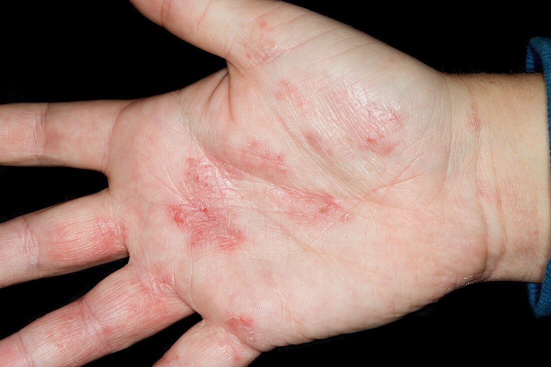 Eczema on the palm