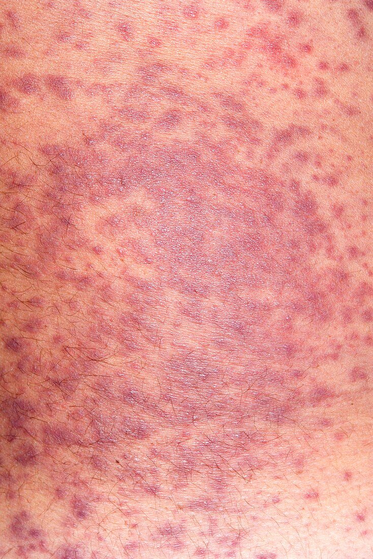 Rash caused by allergy to Trimethoprim