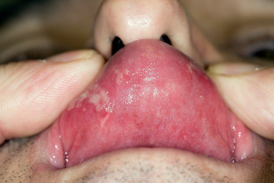 Mouth ulcers caused by drug allergy