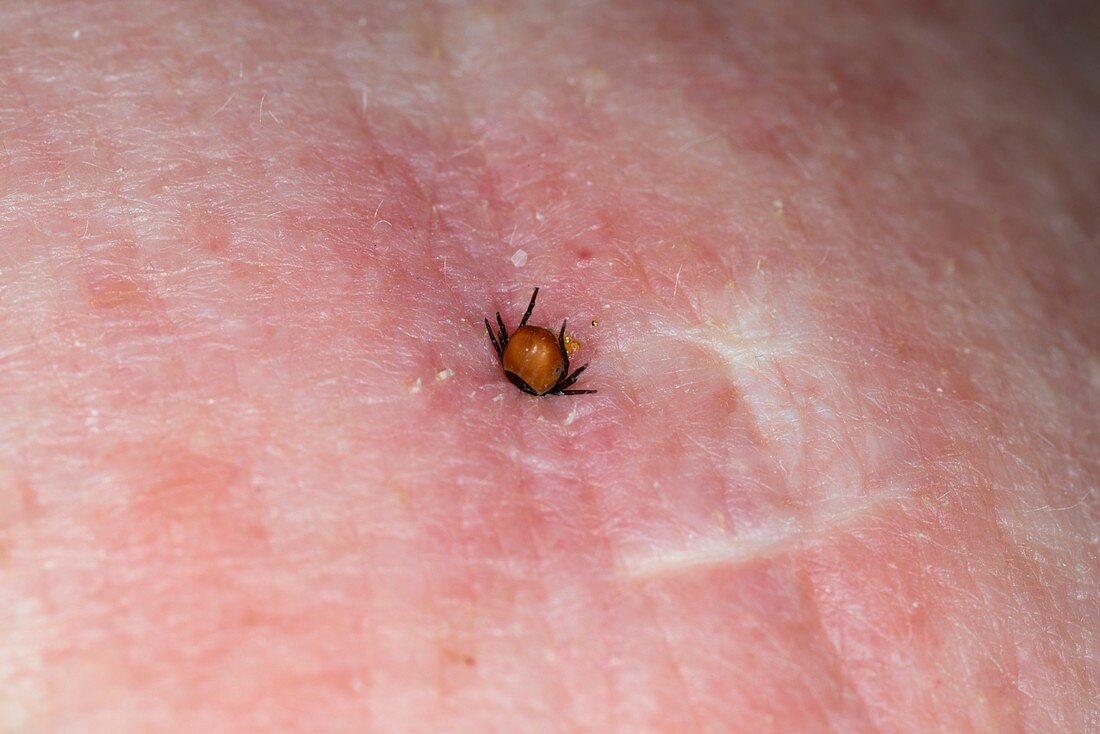 Tick on the abdomen