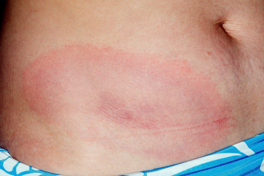 Erythema migrans rash in Lyme disease