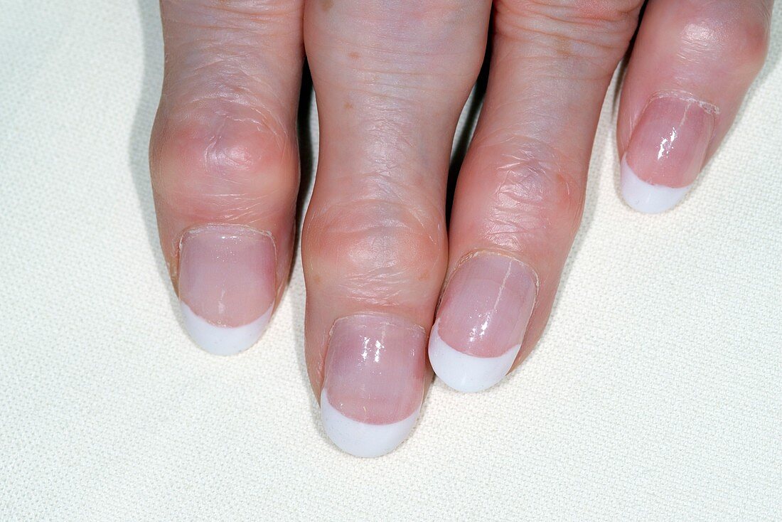 Osteoarthritis of the fingers