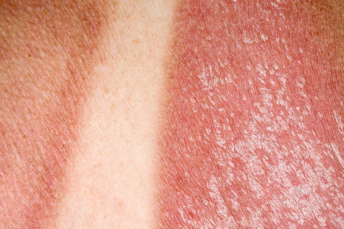 Sunburn