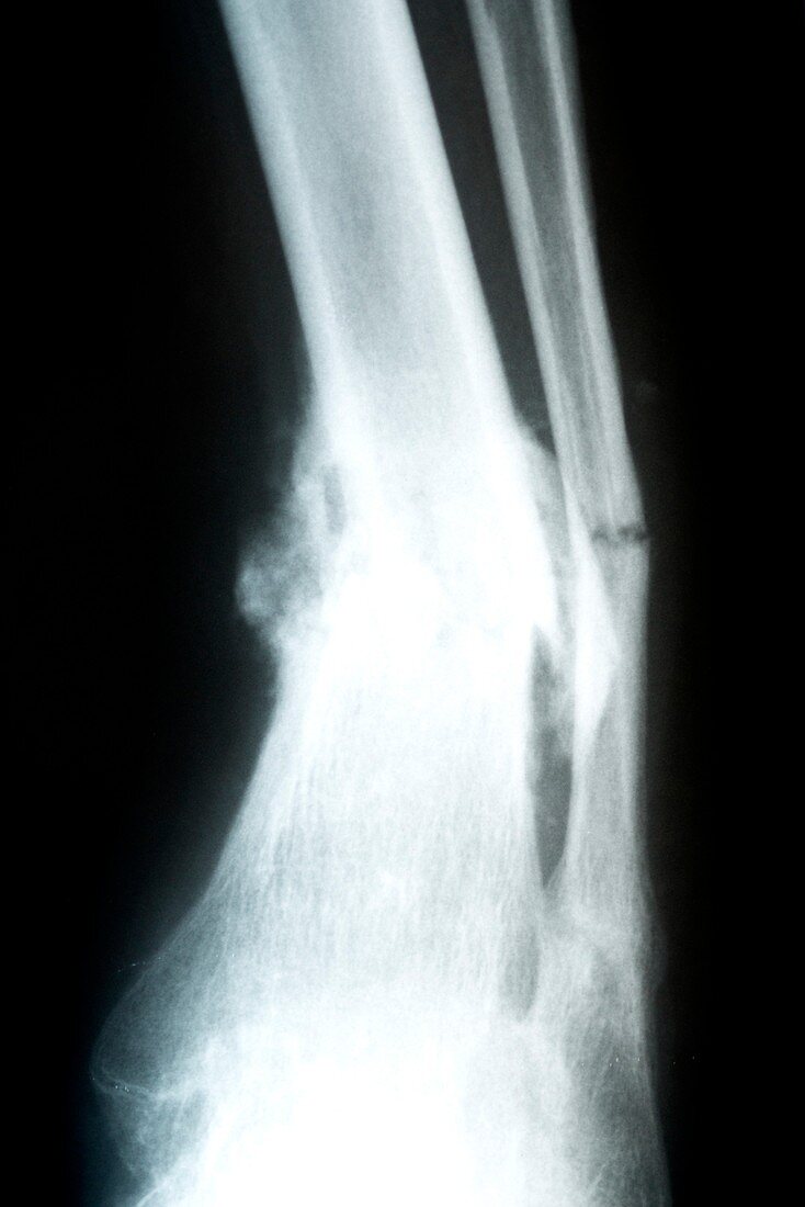 X-ray of fractured tibia and fibula
