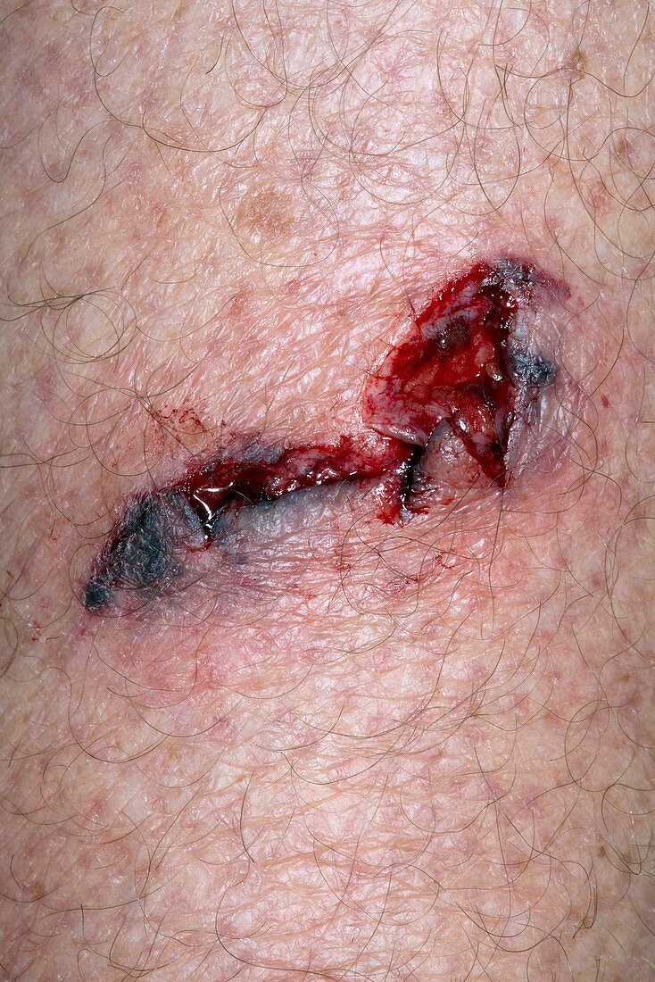 Chainsaw laceration to thigh