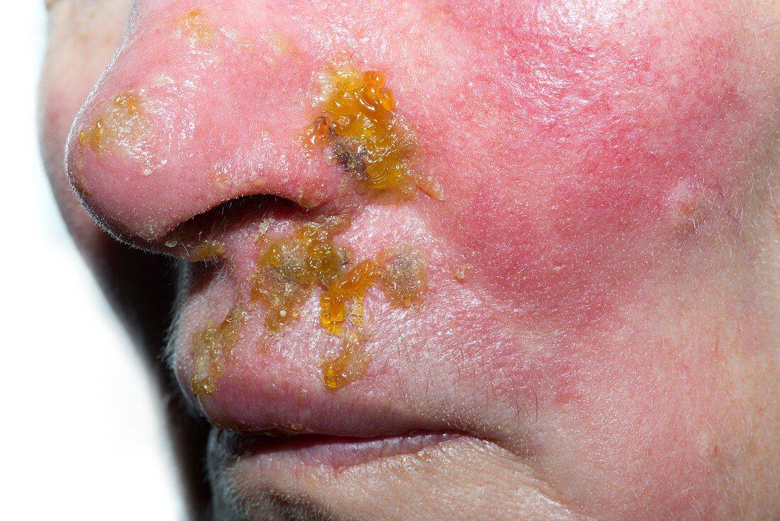 Shingles rash on the face