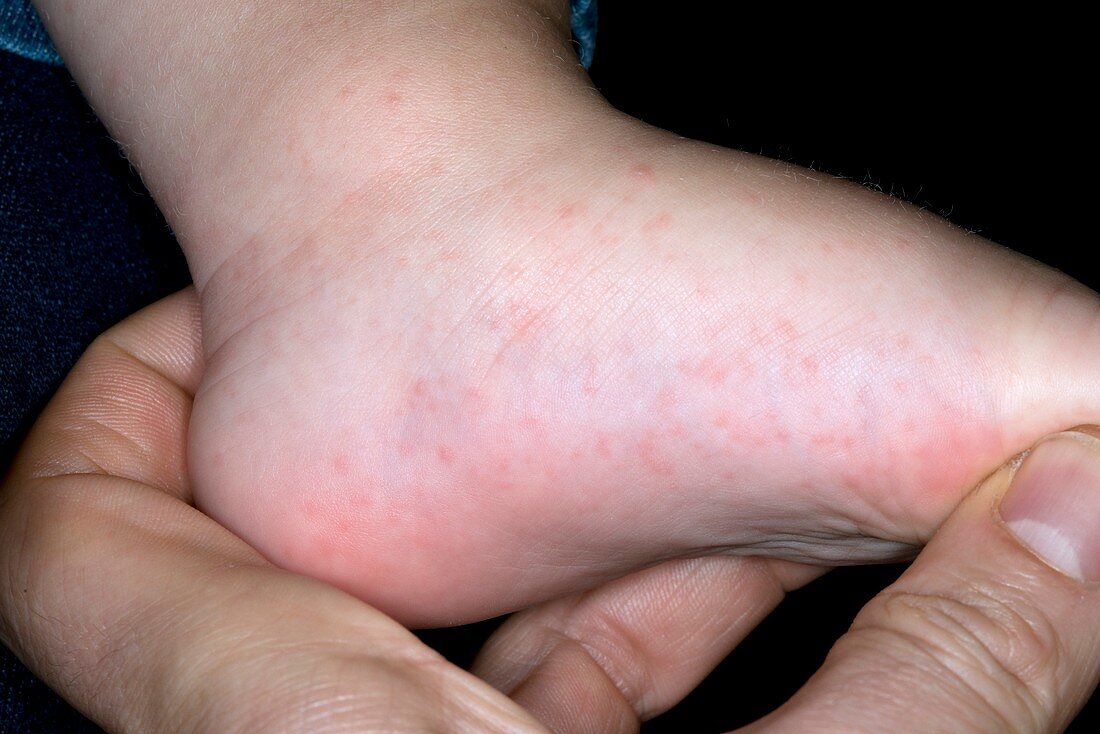 Hand,foot and mouth disease