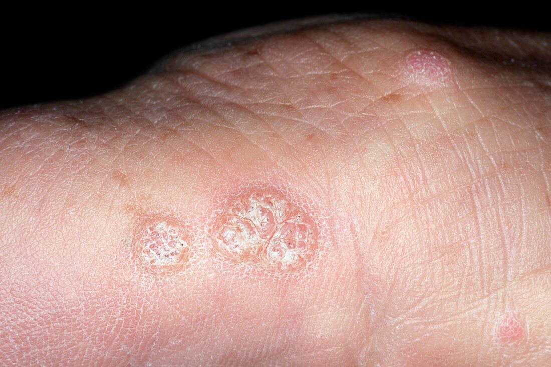 Warts on the hand