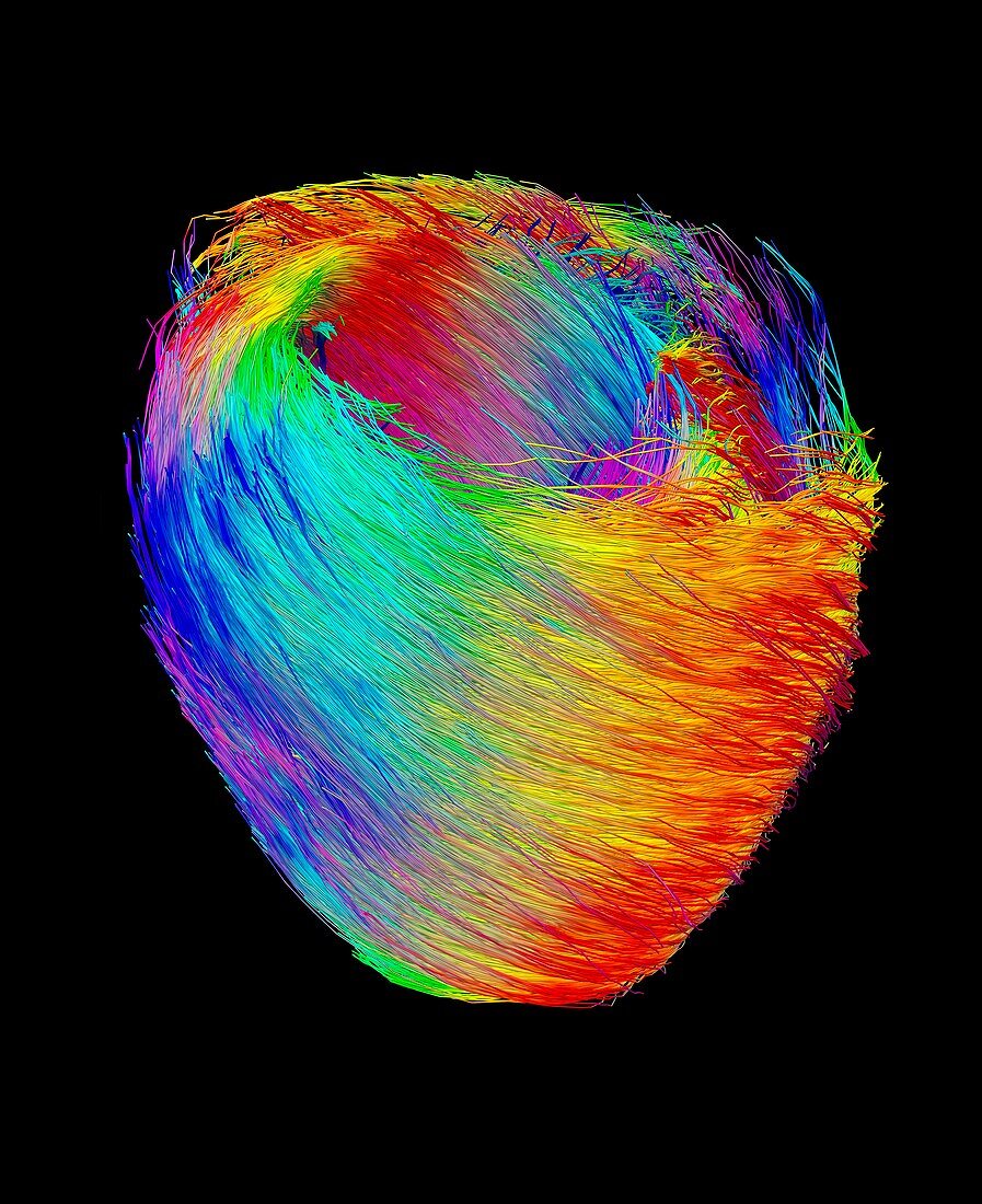 Heart muscle fibres,DTI scan