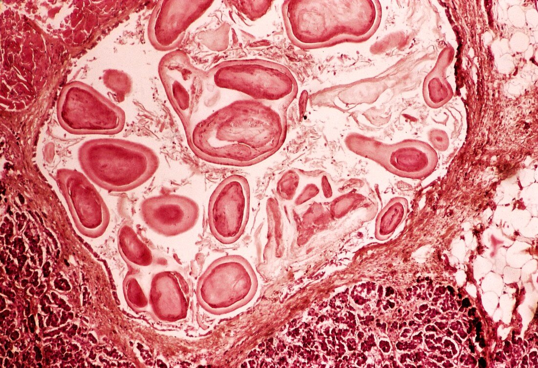 Pancreatic lithiasis,light micrograph