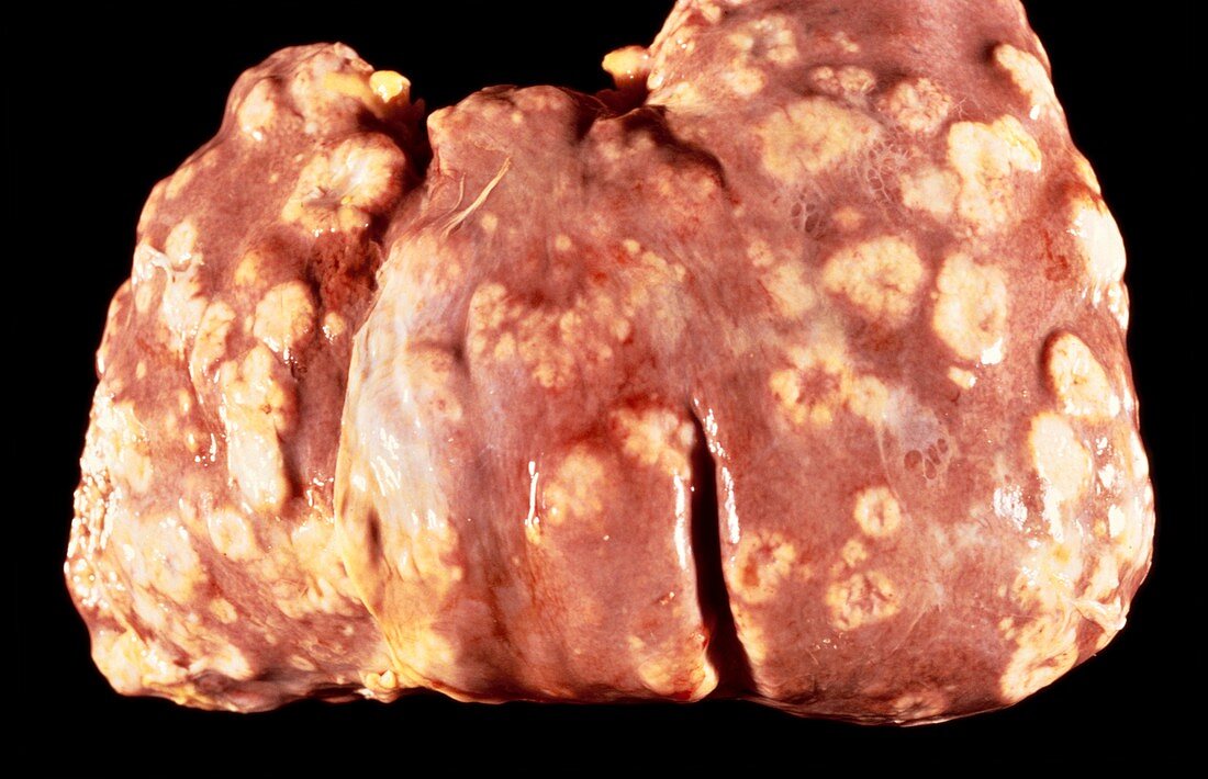 Secondary cancers of the liver