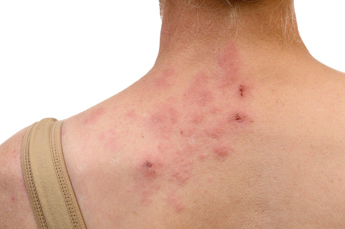 Shingles on the neck